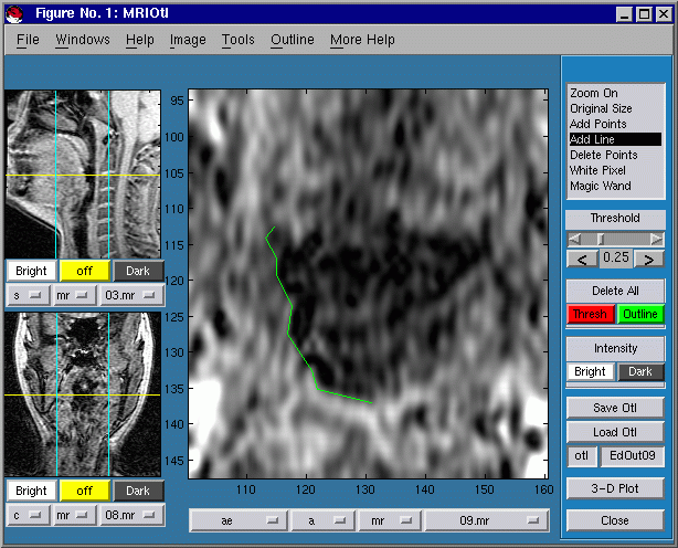 CTMRedit window, in the process of adding a multiline